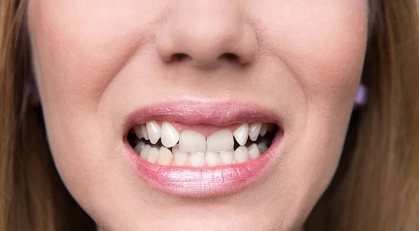 Invisalign for Crooked Teeth